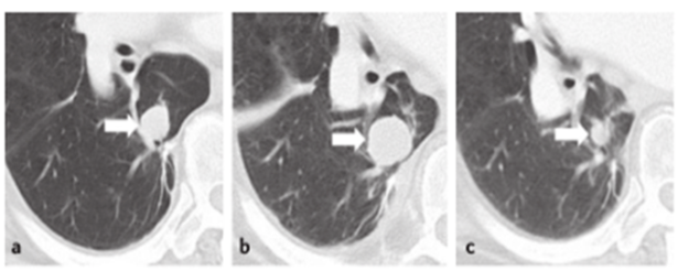 ����EGFR-TKIһ��������һ��ע���ٴ��о������ͬ̽��